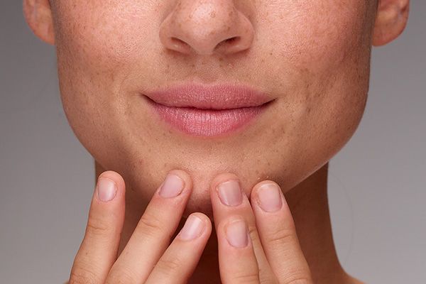 Dry Skin